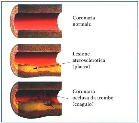 aterosclerotica